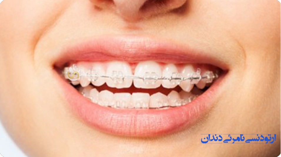 ارتودنسی نامرئی دندان 