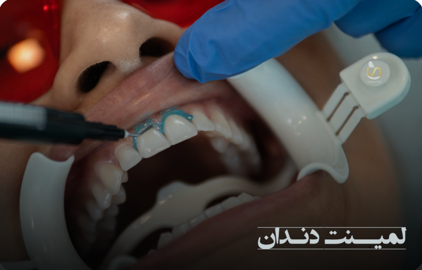 مراحل انجام لمینت دندان و گذاشتن محافظ برای جلوگیری از آسیب به لثه