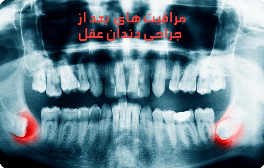 تصویر opg از کل دندان ها و نشان دادن محل قرارگیری دندان عقل نهفته در فک به صورت خوابیده