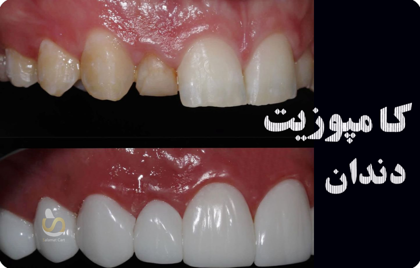 تصویر نمونه کار از قبل و بعد کامپوزیت دندان است