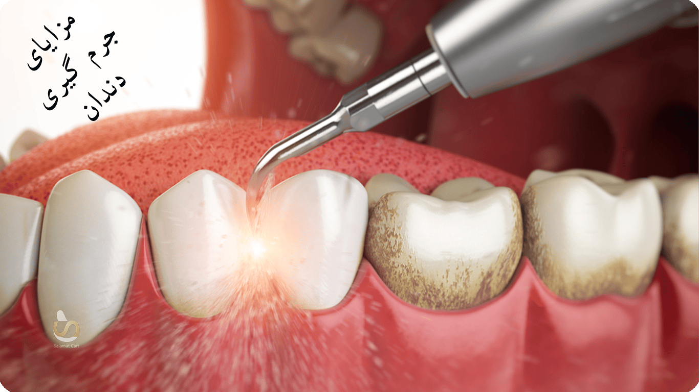 مزایای جرم گیری دندان