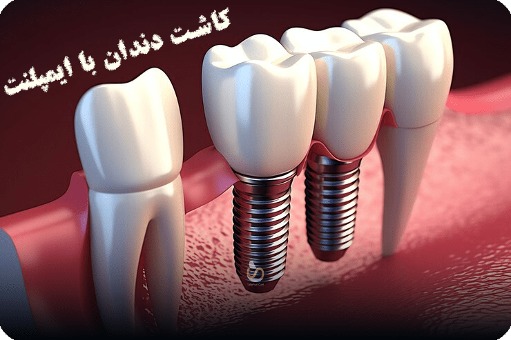 کاشت دندان با ایمپلنت (یک روش دائمی برای دندان‌های از دست رفته)