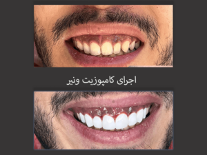 اجرای کامپوزیت ونیر، قیمت کامپوزیت ونیر 1403- سلامت کارت-