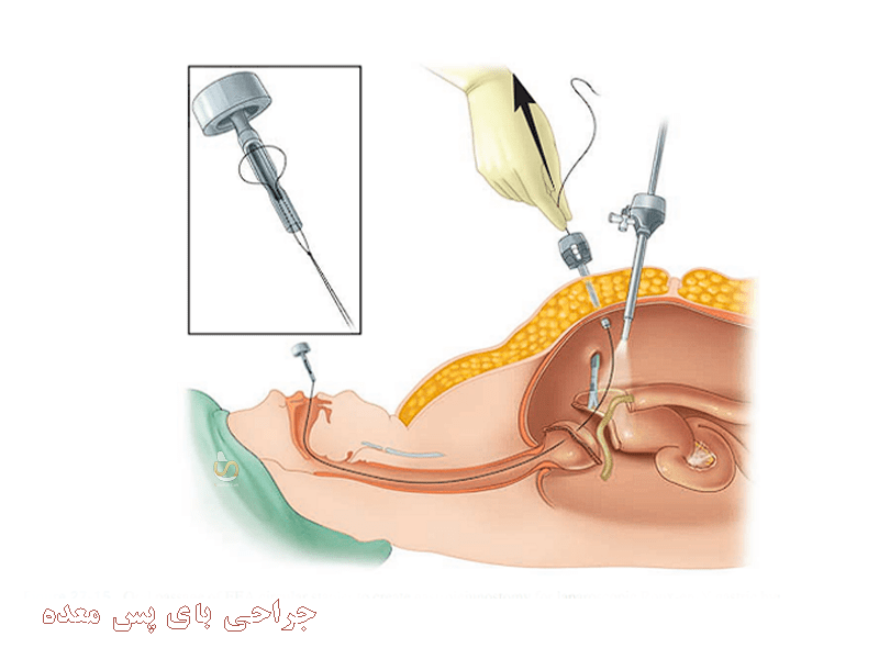 بای پس معده با روش لاپاروسکوپیک- سلامت کارت 