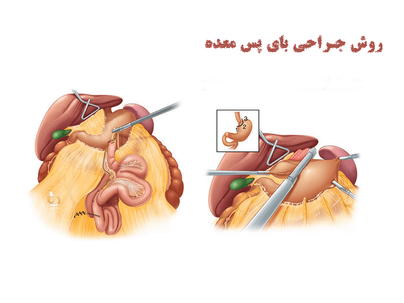 روش جرای بای پس معده- سلامت کارت