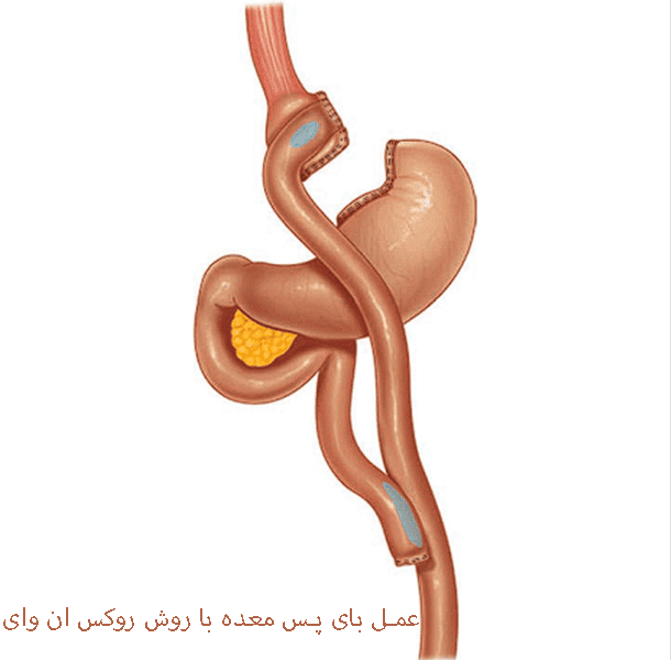 عمل بای پس معده با روش روکس ان وای- سلامت کارت-