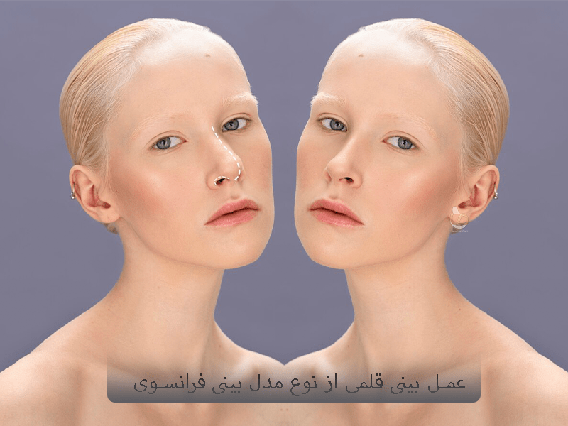 عمل بینی قلمی از نوع مدل بینی فرانسوی- سلامت کارت