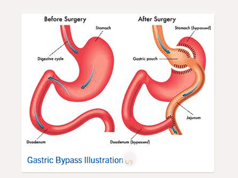 جراحی بای‌پس معده با روش روکس ان وای Roux-en-Y (LRYGB) را بشناسیم