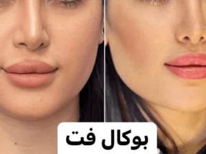 نمونه تغییر چهره با عمل بوکال فت، سلامت کارت