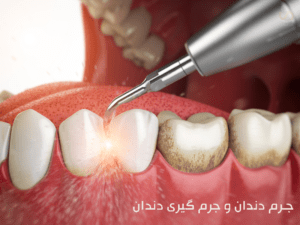 جرم دندان و جرم گیری دندان، سلامت کارت