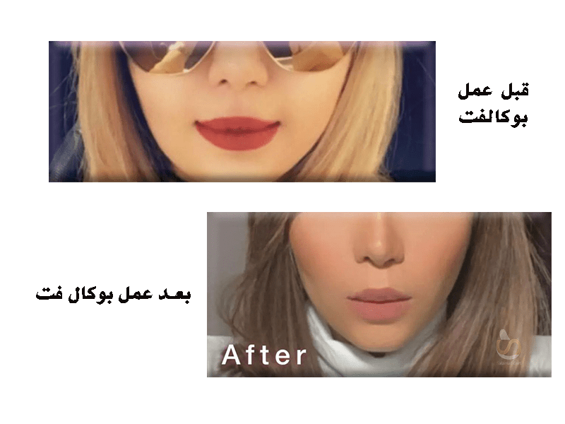 قبل و بعد عمل بوکال فت، سلامت کارت