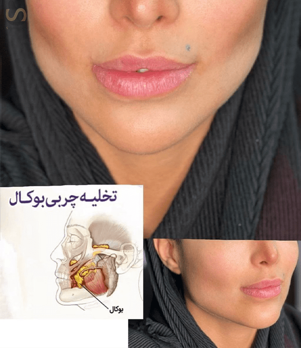 چربی بوکال فت، سلامت کارت