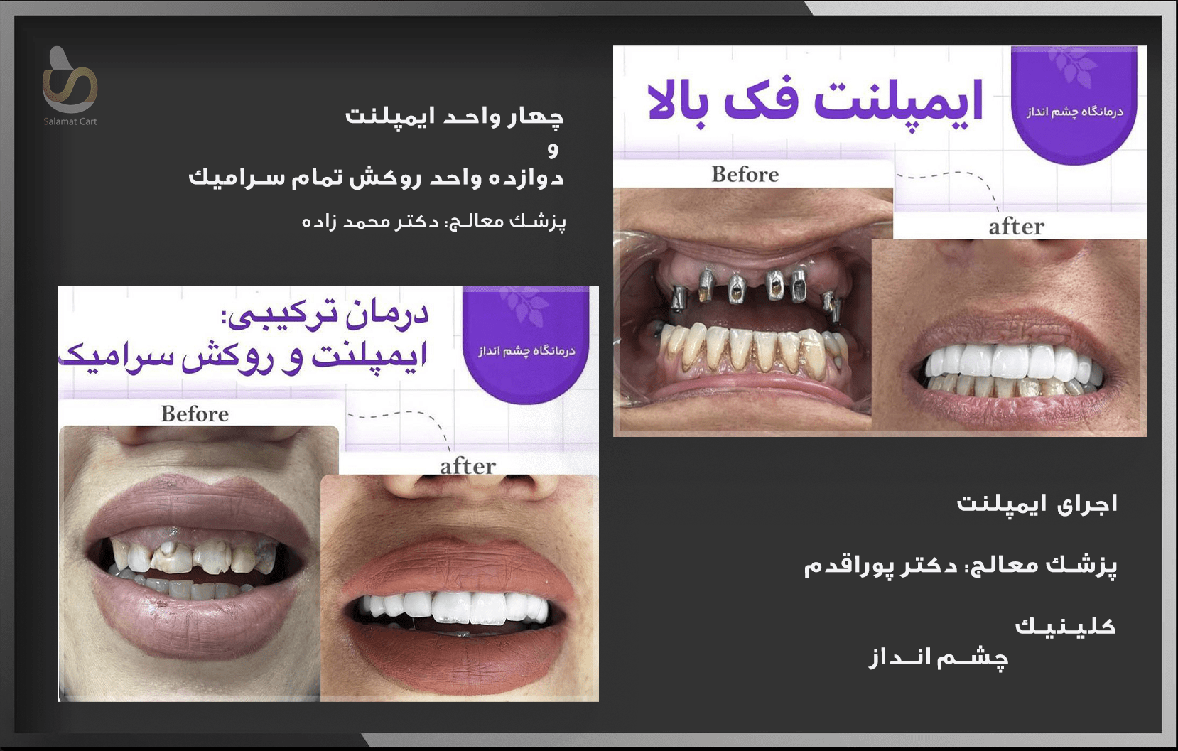 قیمت ایمپلنت دندان 1403 (ایمپلنت قسطی بدون پیش پرداخت+ بدون ضامن)