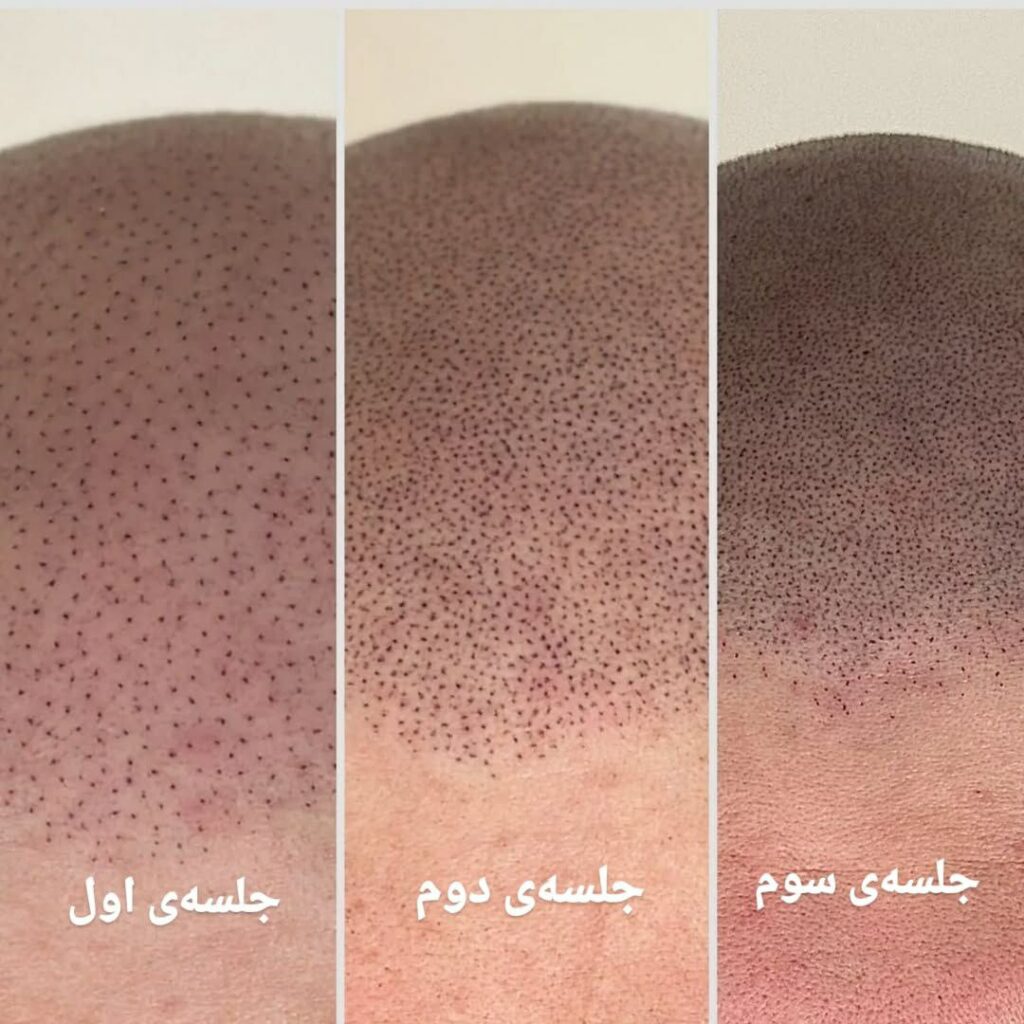 کاشت مو قسطی، سلامت کارت