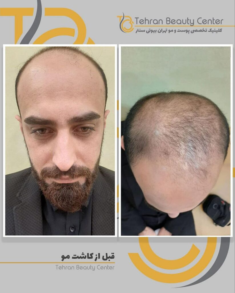 کاشت مو قسطی در تهران- سلامت کارت