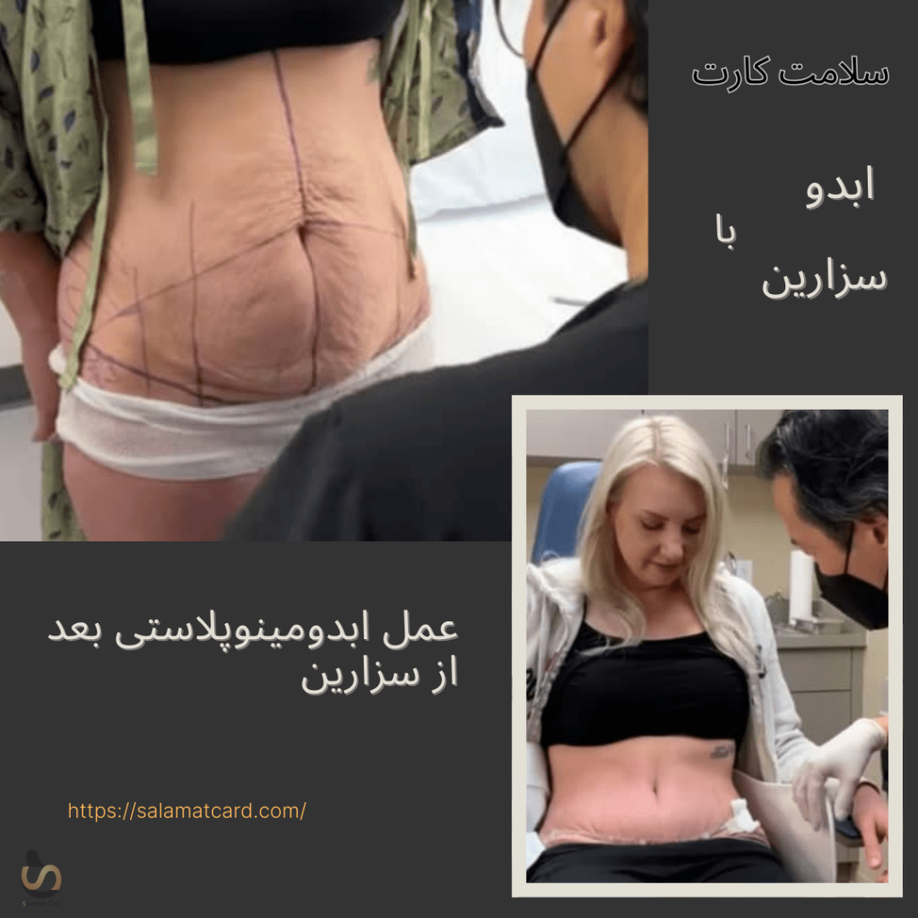 عمل ابدومینوپلاستی بعد از سزارین، سلامت کارت-