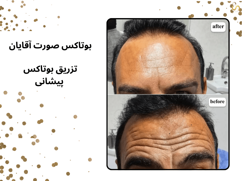 تصویر از پیشانی مرد جوان است که با بوتاکس و تزریق بوتاکس پیشانی تا حدودی صاف شده است. سلامت کارت