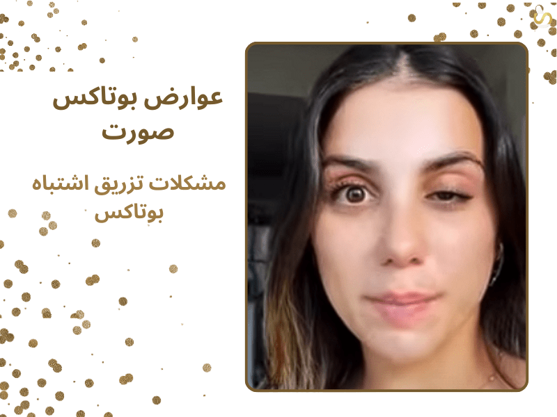 تصویر از دختر جوانی است که با تزریق بوتاکس صورت با خطای تزریق یکی از چشمانش دچار افتادگی پلک شده است.