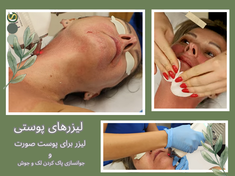 تصویر از خانم جوانی است که لیزر برای درمان پوست انجام داده است. سلامت کارت
