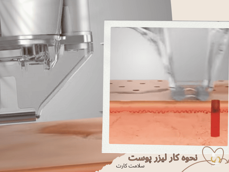 نحوه کار لیزر پوست تصویر گرافیکی است.