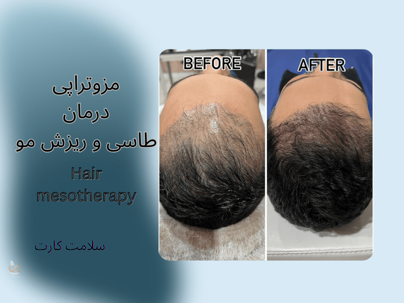 نتیجه مزوتراپی مرد جوان که دچار کم مویی شده است.