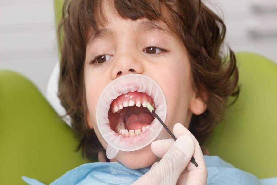 فلوراید دندان با بیمه دندانپزشکی سلامت کارت