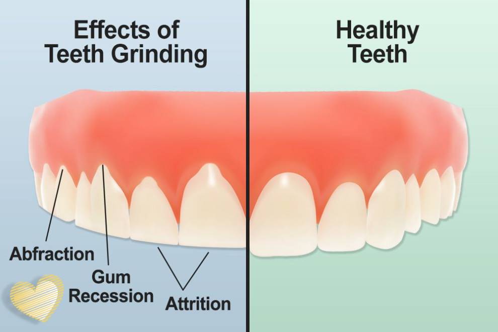 تفاوت دندان سالم با دندانی که در معرض دندان قرچه قرار دارد