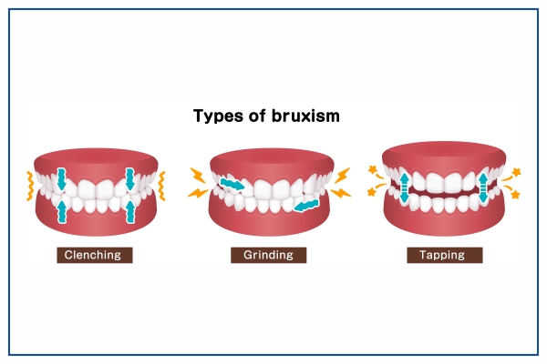 دندان قروچه یا براکسیسم