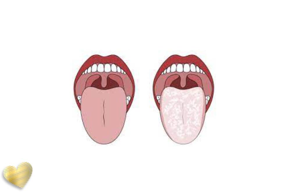 درمان برفک دهان